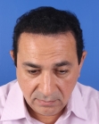 After Hair Transplant&nbsp;Front